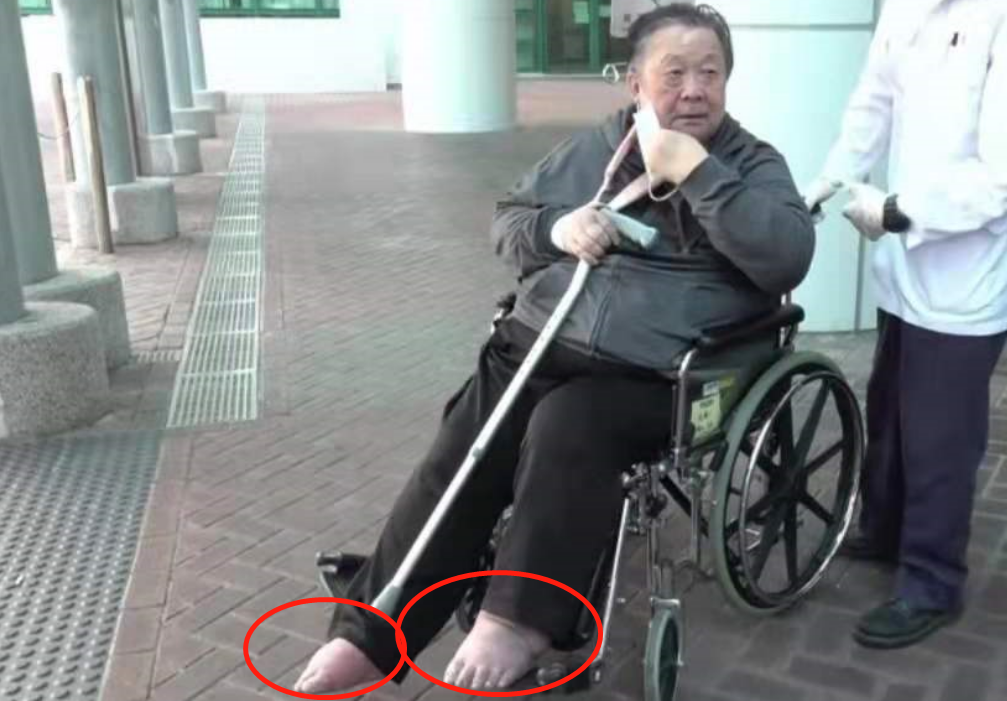 72岁“老顽童”秦煌紧急入院！双脚浮肿，体重高达254斤